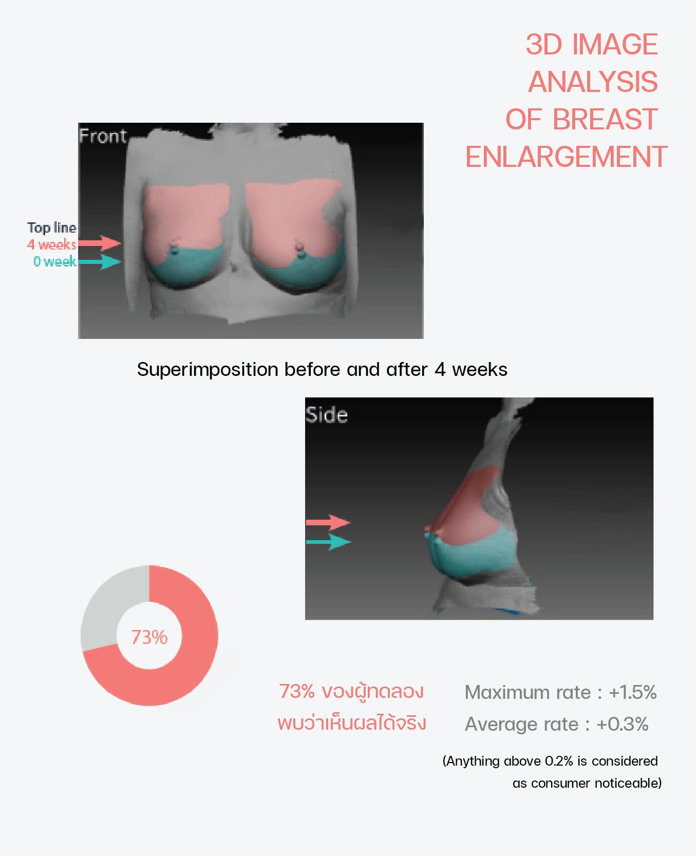 Breast Augmentation with IDEAL IMPLANTS
